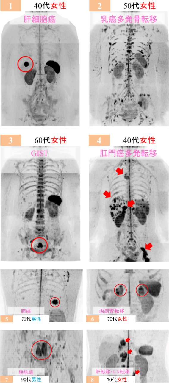 40代女性 肝細胞癌 40代女性 乳癌多発骨転移 50代女性 GIST 50代女性 肛門癌多発転移 50代男性 肺癌 50代男性 両副腎転移 50代男性 膀胱癌 50代女性 肺転移・LN転移