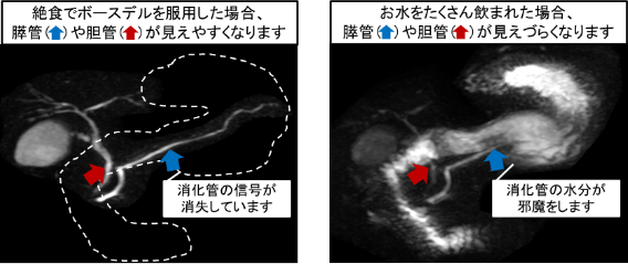 絶食でポースデルを服用した場合、膵管や胆管が見えやすくなります 水をたくさん飲まれた場合、膵管や胆管が見えづらくなります