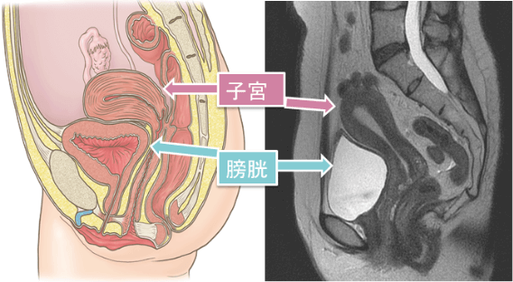 子宮 膀胱