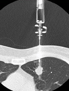 CTガイド下肺生検 専門医 保本卓