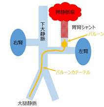 胃静脈瘤に対するBRTO 保本卓