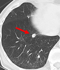 IVR治療　肺がん