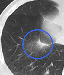 IVR治療　肺癌